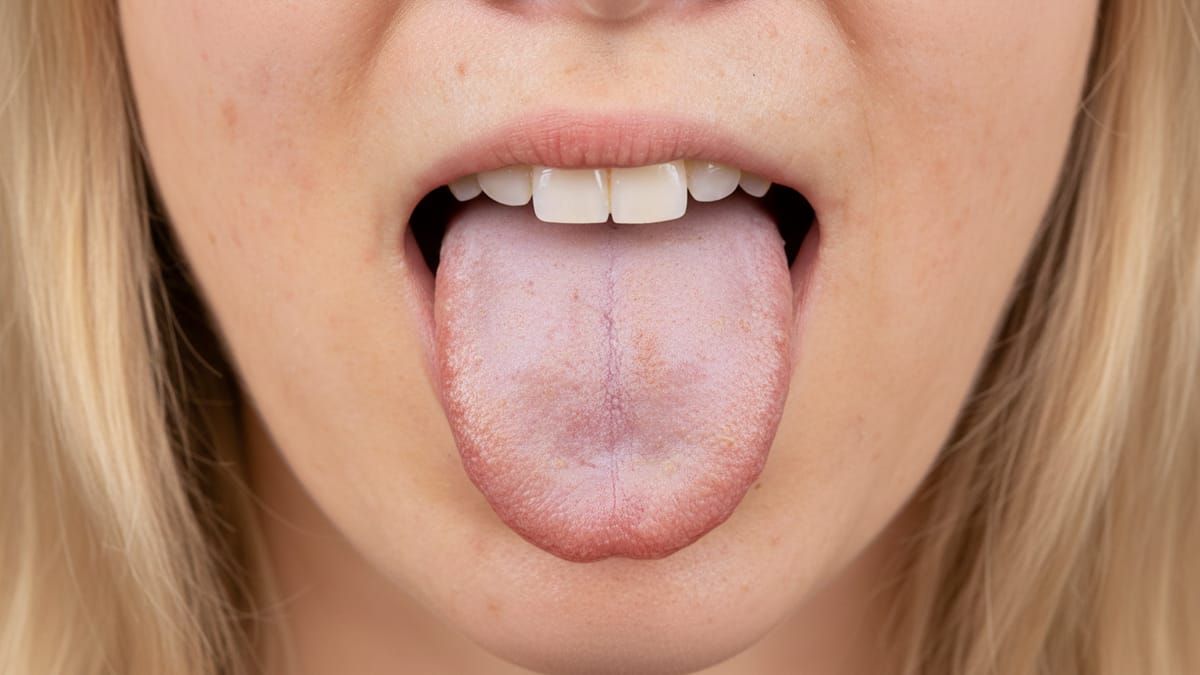 Candidose Buccale : Symptômes, Causes et Traitements de la Mycose Buccale